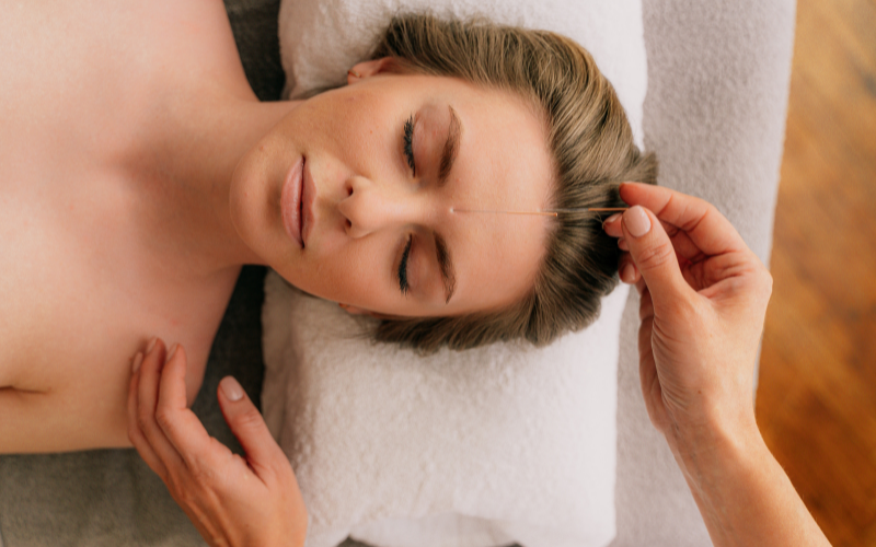 Woman laying on a massage table receiving facial Acupuncture treatment.